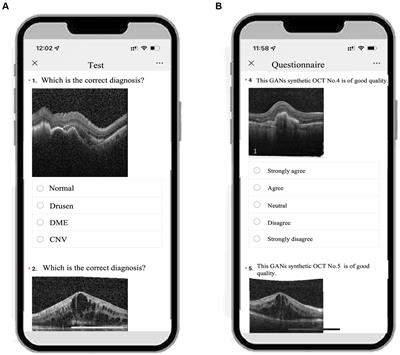 Generative adversarial networks synthetic optical coherence tomography images as an education tool for image diagnosis of macular diseases: a randomized trial